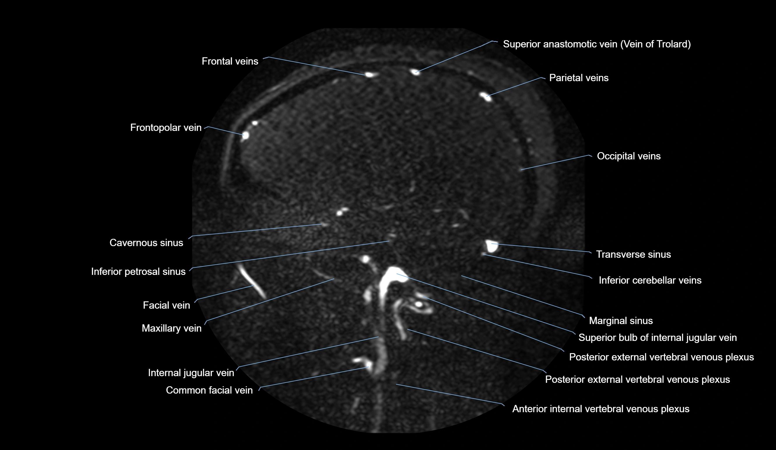 MRV brain sagittal anatomy 3T MRI images -img-01015-00055.webp